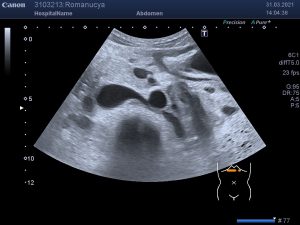 Допплерография артерий почек