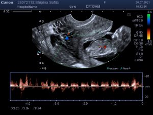 УЗИ-первого-триместра-беременности-1