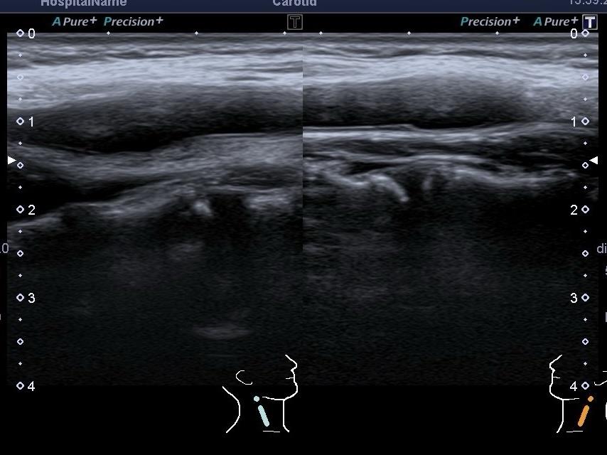 УЗД судин шиї MEDICINE GROUP