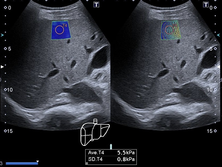 Еластографія печінки Київ