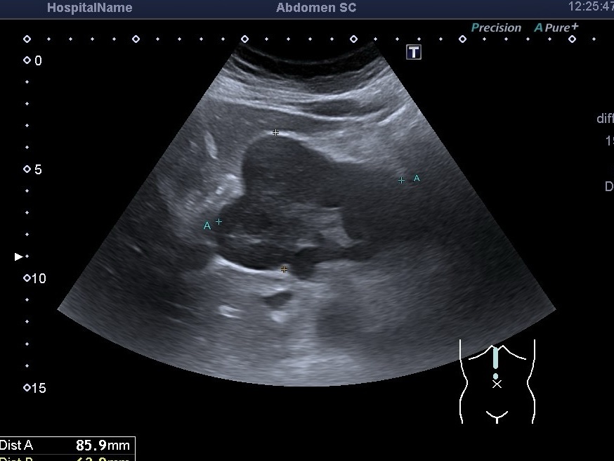 УЗД органів черевної порожнини