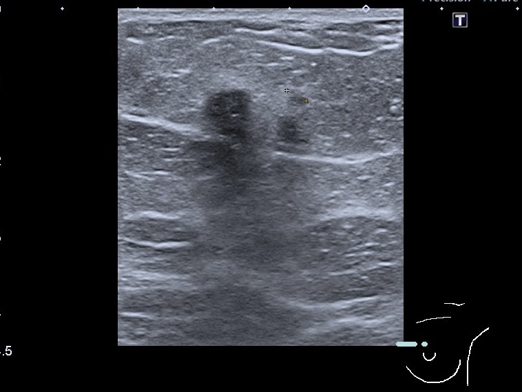 УЗД молочних залоз Medicinе group