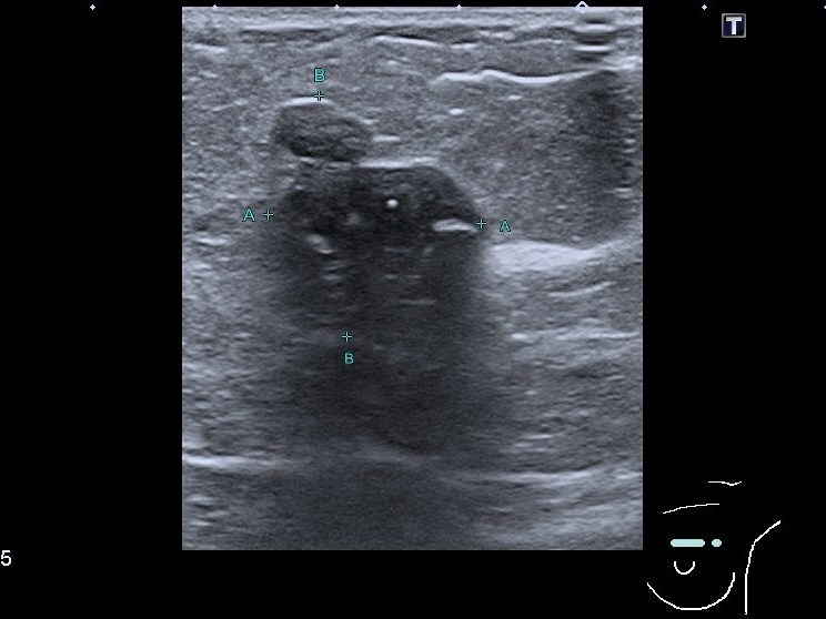УЗИ молочных желёз