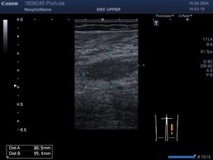 УЗД нервів при травмах