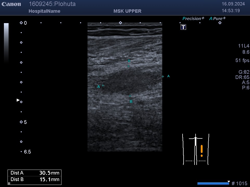 УЗД нервів при травмах