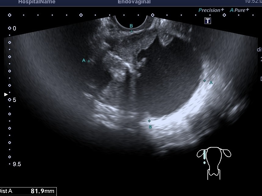 УЗИ малого таза