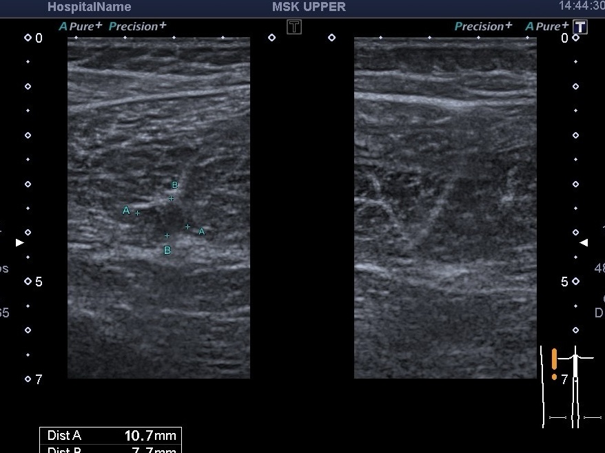 УЗД при травмах м’язів