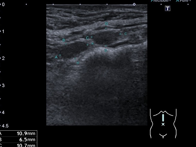 УЗД селезінки