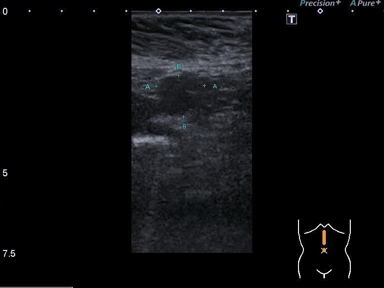 УЗИ селезенки