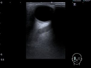 доплерографія судин ока