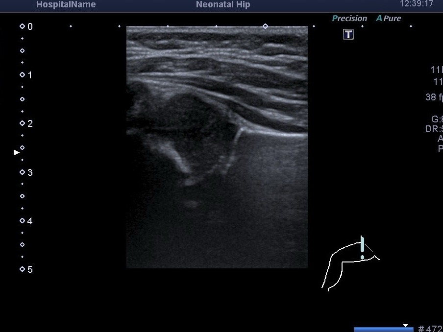 УЗД кульшових суглобів у дітей до року