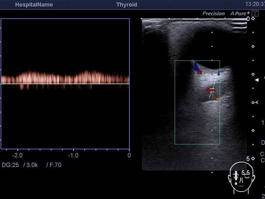 УЗИ орбиты и допплерография сосудов глаза