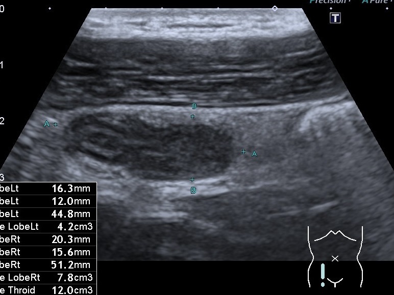 гострий живіт