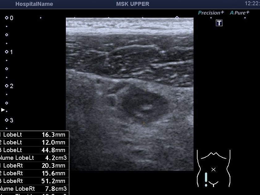 УЗД при апендициті 