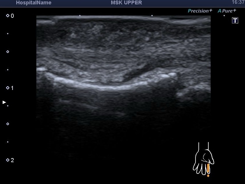 УЗД м’яких тканин китиці та стопи