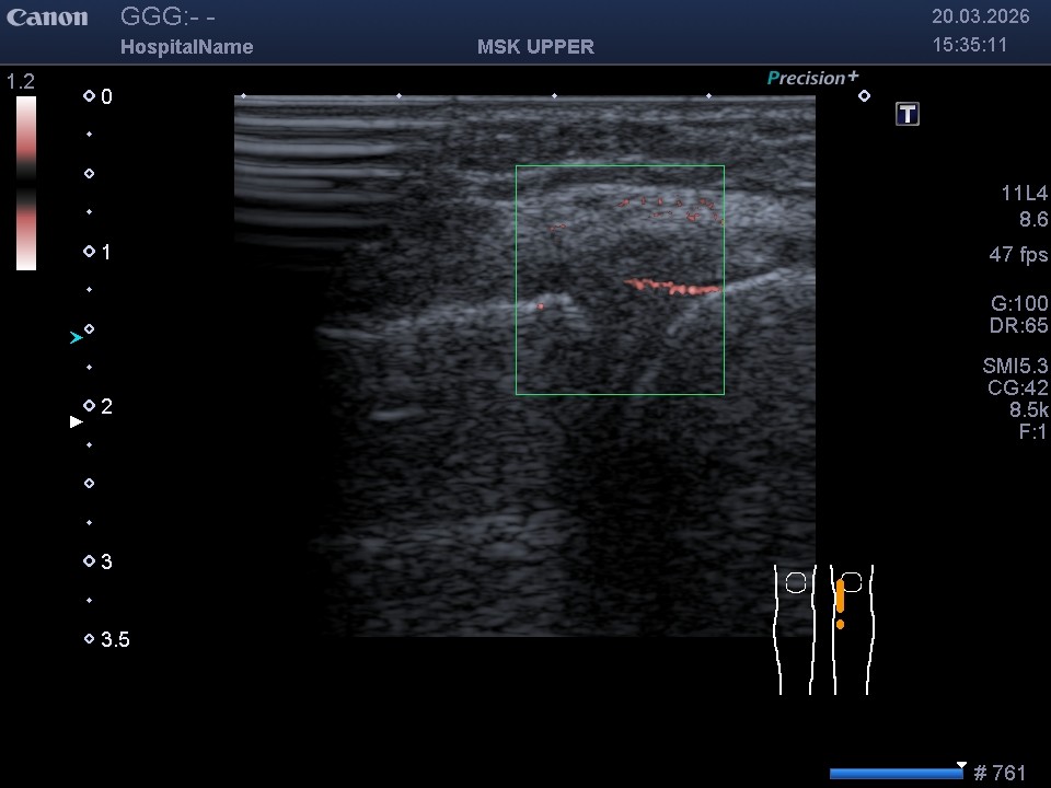 УЗД меніска