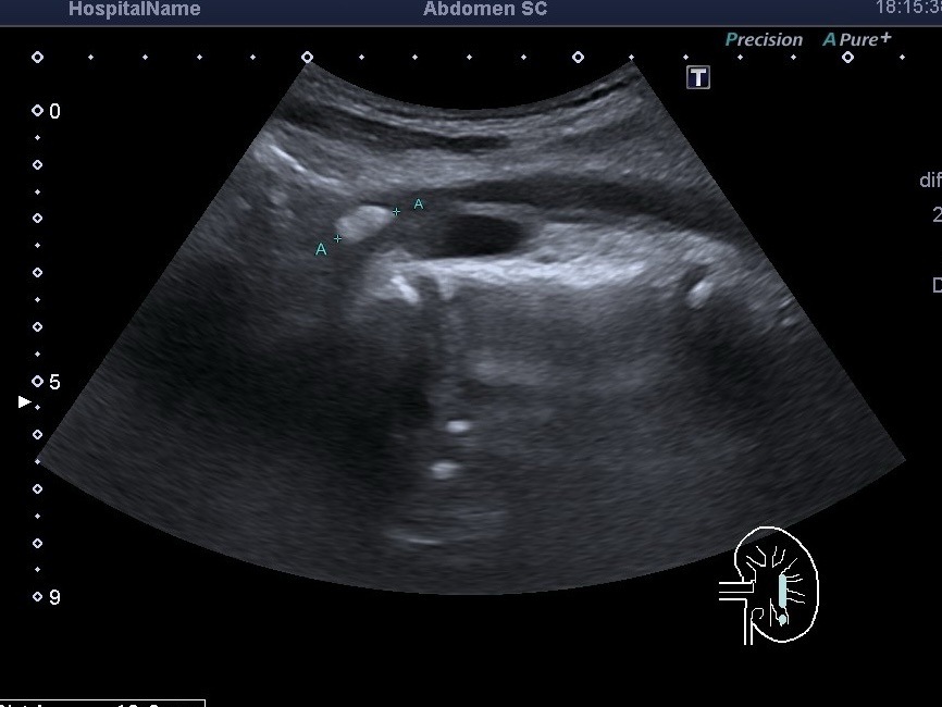 УЗД нирок та сечового міхура метро Кловська