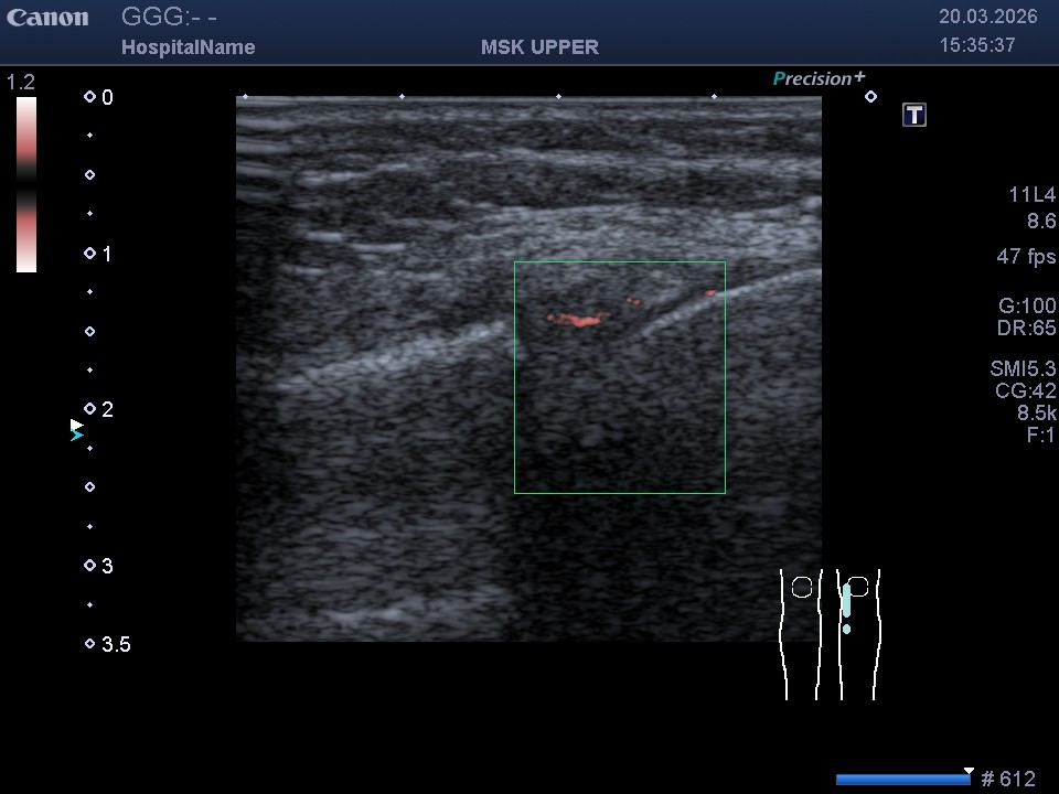 УЗИ мениска