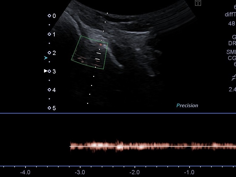 УЗИ мениска киев