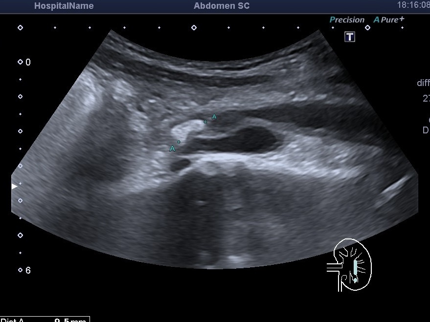 УЗИ почек и мочевого пузыря на Кловской