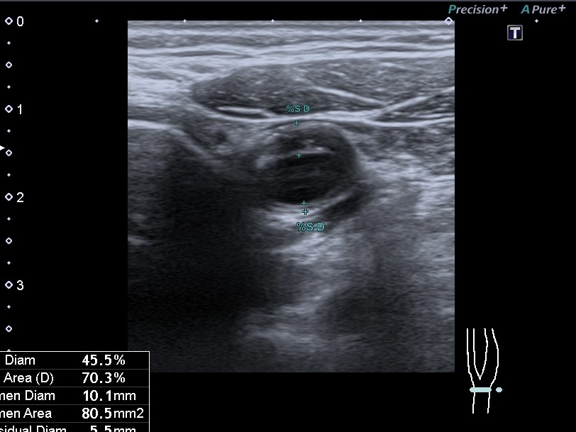 ризик інсульту
