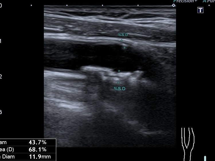 типи атеросклеротичних бляшок