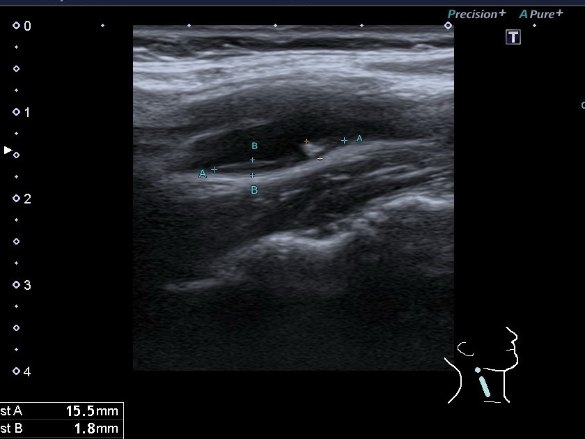 Типы атеросклеротических бляшек узи