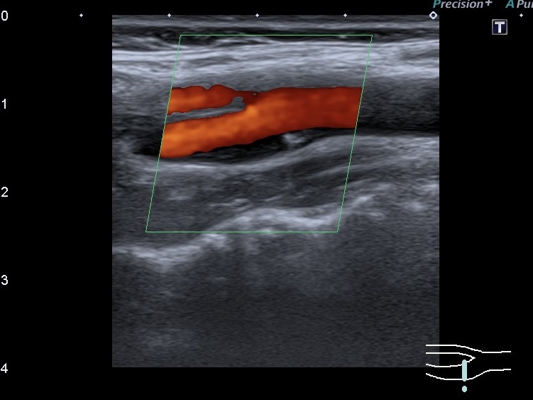 Типы атеросклеротических бляшек